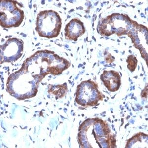 Formalin-fixed paraffin-embedded Human Breast Carcinoma stained with Ferritin LC Rabbit Recombinant Monoclonal Antibody (FTL/2338R).