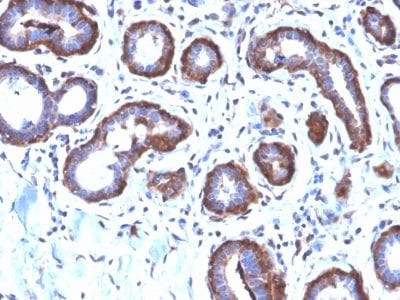 Formalin-fixed paraffin-embedded Human Breast Carcinoma stained with Ferritin LC Rabbit Recombinant Monoclonal Antibody (FTL/2338R).