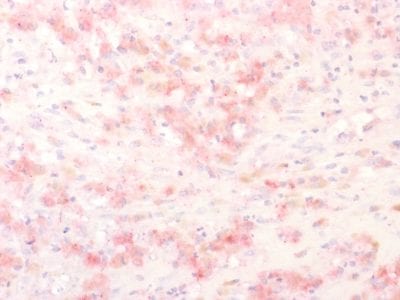 Formalin-fixed paraffin-embedded human Melanoma stained with TYRP1 Recombinant Rabbit Monoclonal Antibody (TYRP1/2340R);using AEC Chromogen.