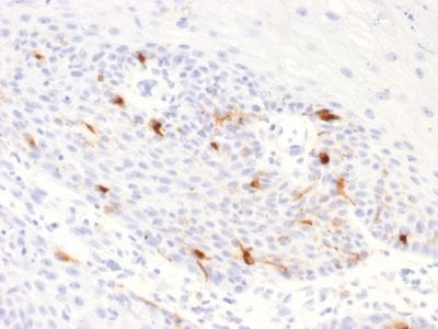 Formalin-fixed paraffin-embedded human Basal Cell Carcinoma stained with TYRP1 Recombinant Rabbit Monoclonal Antibody (TYRP1/2340R).