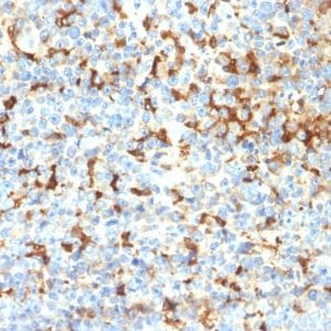 Formalin-fixed paraffin-embedded human Melanoma stained with TYRP1 Recombinant Rabbit Monoclonal Antibody (TYRP1/2340R); using DAB Chromogen.