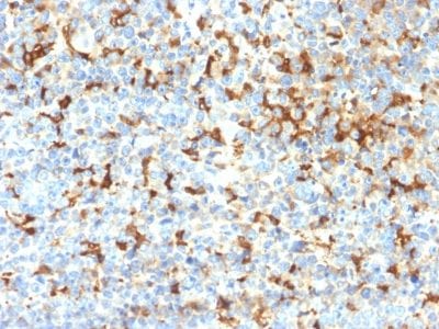 Formalin-fixed paraffin-embedded human Melanoma stained with TYRP1 Recombinant Rabbit Monoclonal Antibody (TYRP1/2340R); using DAB Chromogen.