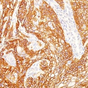 Formalin-fixed paraffin-embedded human Lung SqCC stained with EGFR Mouse Monoclonal Antibody (GFR/2341).