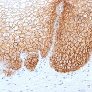 Formalin-fixed paraffin-embedded human Cervical Carcinoma stained with CD44v9 Mouse Recombinant Monoclonal Antibody (rCD44v9/1459).