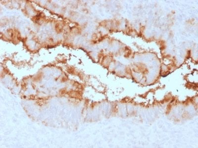 Formalin-fixed paraffin-embedded human Endometrial Carcinoma stained withMUC16 Rabbit Recombinant Monoclonal Antibody (OCA125/2349R).