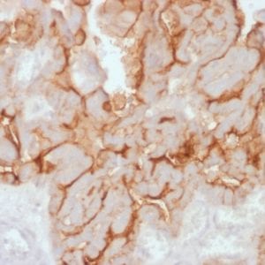 Formalin-fixed paraffin-embedded human Ovarian Carcinoma stained with MUC16 Rabbit Recombinant Monoclonal Antibody (OCA125/2349R).