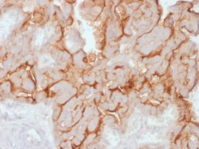 Formalin-fixed paraffin-embedded human Ovarian Carcinoma stained with MUC16 Rabbit Recombinant Monoclonal Antibody (OCA125/2349R).
