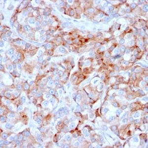 Formalin-fixed paraffin-embedded human Gastric Carcinoma stained with CD269 Mouse Monoclonal Antibody (BCMA/2366).