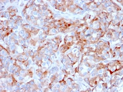 Formalin-fixed paraffin-embedded human Gastric Carcinoma stained with CD269 Mouse Monoclonal Antibody (BCMA/2366).