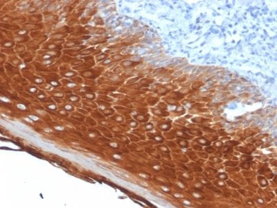 Formalin-fixed paraffin-embedded human Basal Cell stained with Cytokeratin 6A (KRT6A) Mouse Monoclonal Antibody (KRT6A/2368).
