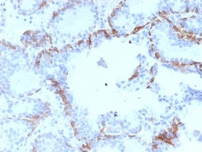 Formalin-fixed paraffin-embedded human Prostate Carcinoma stained with Cytokeratin 6A (KRT6A) Mouse Monoclonal Antibody (KRT6A/2368).
