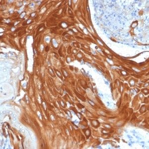 Formalin-fixed paraffin-embedded human Basal Cell Carcinoma stained with Cytokeratin 6A (KRT6A) Mouse Monoclonal Antibody (KRT6A/2368).