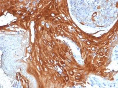 Formalin-fixed paraffin-embedded human Basal Cell Carcinoma stained with Cytokeratin 6A (KRT6A) Mouse Monoclonal Antibody (KRT6A/2368).