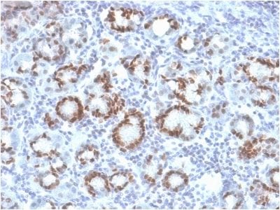 Formalin-fixed paraffin-embedded human Gastric Carcinoma stained with SOX9 Mouse Monoclonal Antibody (SOX9/2387).