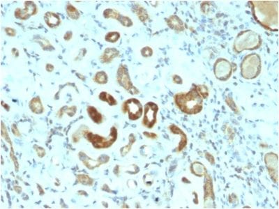 Formalin-fixed paraffin-embedded human Renal Cell Carcinoma stained with STAT3 Mouse Monoclonal Antibody (STAT3/2409).