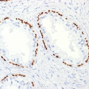 Formalin-fixed paraffin-embedded human Prostate Carcinoma stained with p63 Mouse Monoclonal Antibody (TP63/2427).