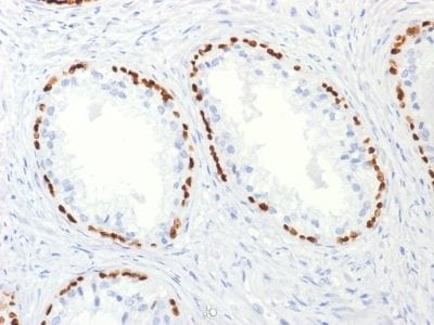 Formalin-fixed paraffin-embedded human Prostate Carcinoma stained with p63 Mouse Monoclonal Antibody (TP63/2427).