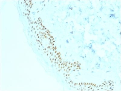 Formalin-fixed paraffin-embedded human Basal Cell Carcinoma stained with p63 Mouse Monoclonal Antibody (TP63/2428).