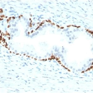Formalin-fixed paraffin-embedded human Prostate Carcinoma stained with p63 Mouse Monoclonal Antibody (TP63/2428).
