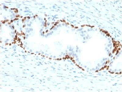 Formalin-fixed paraffin-embedded human Prostate Carcinoma stained with p63 Mouse Monoclonal Antibody (TP63/2428).