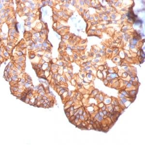 Formalin-fixed paraffin-embedded Human Breast Carcinoma stained with HER-2 Mouse Monoclonal Antibody (ERBB2/2452).