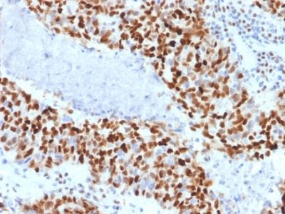 Formalin-fixed paraffin-embedded Human Colon Carcinoma stained with Cyclin E Mouse Monoclonal Antibody (CCNE1/2460).