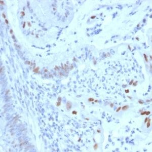 Formalin-fixed paraffin-embedded Human Colon Carcinoma stained with Cyclin E Mouse Monoclonal Antibody (CCNE1/2460).
