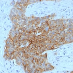 Formalin-fixed paraffin-embedded human Tongue stained with GLUT-1 Mouse Monoclonal Antibody (GLUT1/2475).