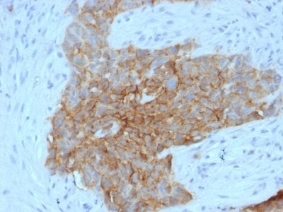 Formalin-fixed paraffin-embedded human Tongue stained with GLUT-1 Mouse Monoclonal Antibody (GLUT1/2475).