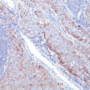 Formalin-fixed paraffin-embedded human Breast Carcinoma stained with GLUT-1 Mouse Monoclonal Antibody (GLUT1/2476).