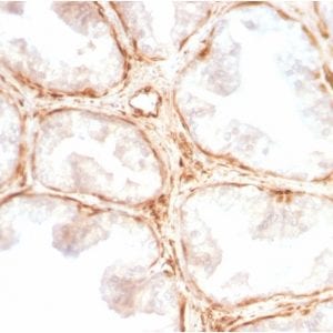 Formalin-fixed paraffin-embedded Human Prostate Carcinoma stained with Galectin-1 Rabbit Recombinant Monoclonal Antibody (GAL1/2499R).