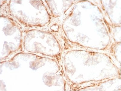 Formalin-fixed paraffin-embedded Human Prostate Carcinoma stained with Galectin-1 Rabbit Recombinant Monoclonal Antibody (GAL1/2499R).