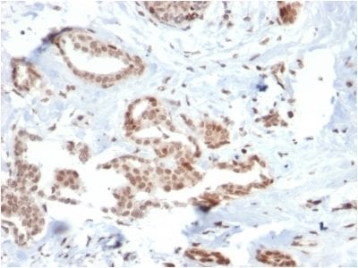 Formalin-fixed paraffin-embedded human Breast Carcinoma stained with SOX4 Mouse Monoclonal Antibody (SOX4/2540).