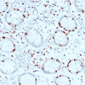 Formalin-fixed paraffin-embedded human Colon Carcinoma stained with SOX4 Mouse Monoclonal Antibody (SOX4/2540).