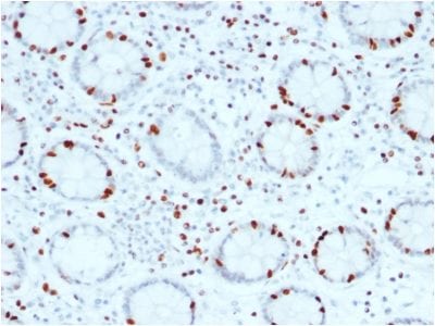 Formalin-fixed paraffin-embedded human Colon Carcinoma stained with SOX4 Mouse Monoclonal Antibody (SOX4/2540).