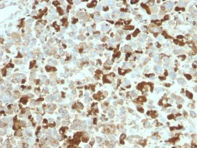 Formalin-fixed paraffin-embedded human Melanoma stained with NGFR Rabbit Recombinant Monoclonal Antibody (NGFR/2550R).