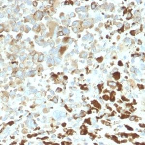 Formalin-fixed paraffin-embedded human Melanoma stained with NGFR Rabbit Recombinant Monoclonal Antibody (NGFR/2550R).