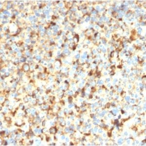 Formalin-paraffin human Melanoma stained with CD63 Recombinant Mouse Monoclonal Antibody (rMX-49.129.5).
