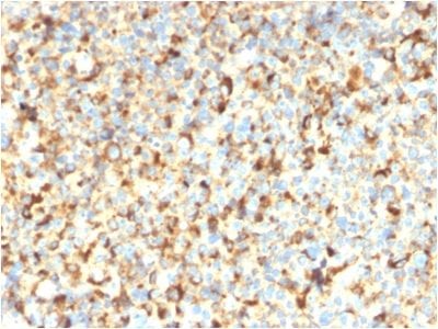 Formalin-paraffin human Melanoma stained with CD63 Recombinant Mouse Monoclonal Antibody (rMX-49.129.5).