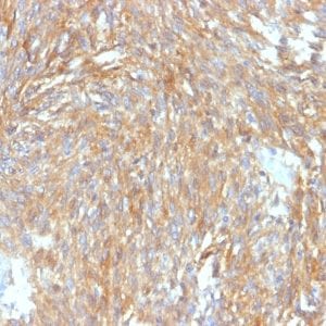 Formalin-fixed paraffin-embedded human GIST stained with DOG-1 Rabbit Recombinant Monoclonal Antibody (DG1/2564R).