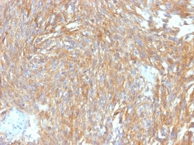 Formalin-fixed paraffin-embedded human GIST stained with DOG-1 Rabbit Recombinant Monoclonal Antibody (DG1/2564R).