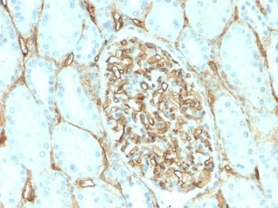 Formalin-fixed paraffin-embedded human Renal Cell Carcinoma stained with CD34 Recombinant Rabbit Monoclonal Antibody (HPCA1/2598R).
