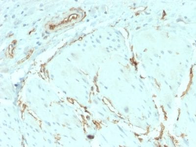 Formalin-fixed paraffin-embedded human Breast Carcinoma stained with CD34 Recombinant Rabbit Monoclonal Antibody (HPCA1/2598R).