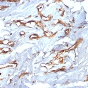 Formalin-fixed paraffin-embedded human Angiosarcoma stained with CD34 Recombinant Rabbit Monoclonal Antibody (HPCA1/2598R).