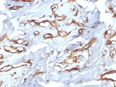 Formalin-fixed paraffin-embedded human Angiosarcoma stained with CD34 Recombinant Rabbit Monoclonal Antibody (HPCA1/2598R).