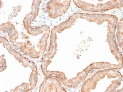 Formalin-fixed paraffin-embedded human Prostate Carcinoma stained with Interleukin 10 Recombinant Rabbit Monoclonal Antibody (IL10/2651R).
