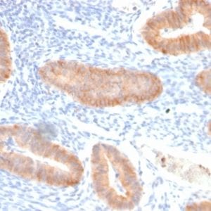 Formalin-fixed paraffin-embedded human Endo-cervical Carcinoma stained with Interleukin 10 Recombinant Rabbit Monoclonal Antibody (IL10/2651R).
