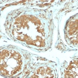 Formalin-fixed paraffin-embedded human Testicular Carcinoma stained with B7-H4 Rabbit Recombinant Monoclonal Antibody (B7H4/2652R).