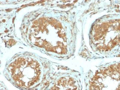 Formalin-fixed paraffin-embedded human Testicular Carcinoma stained with B7-H4 Rabbit Recombinant Monoclonal Antibody (B7H4/2652R).
