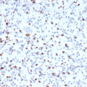 Formalin-fixed paraffin-embedded human Rhabdomyosarcoma stained with Myogenin Mouse Monoclonal Antibody (MYOG/2660)